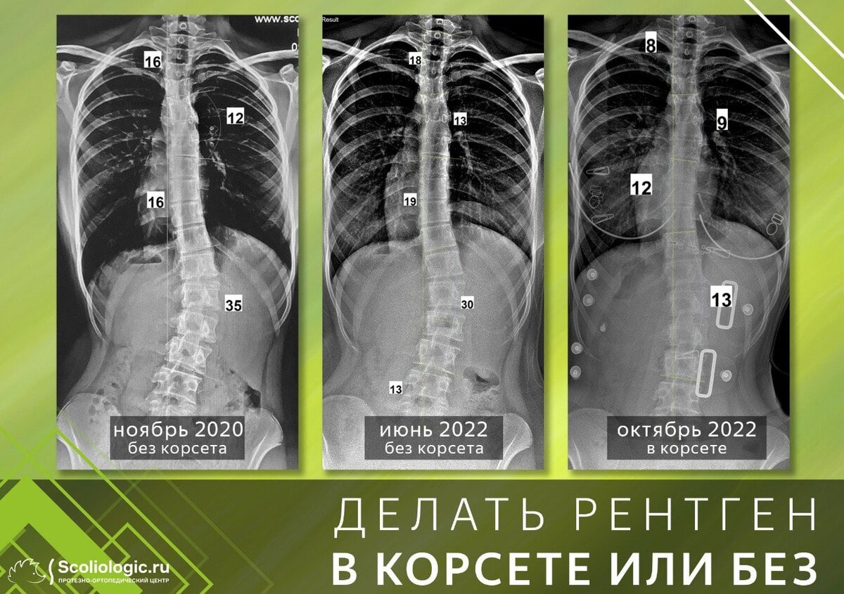 Рентген делать в корсете или без? | Протезно-ортопедический центр | Дзен