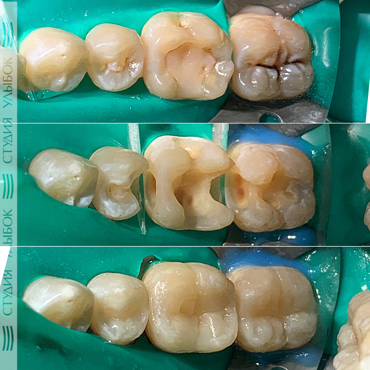 Лечение среднего кариеса 35,36,37 зубов в одно посещение