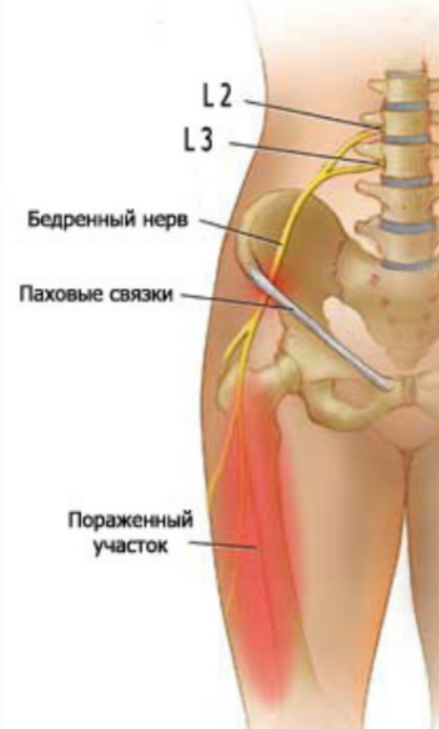 Защемление нерва в тазобедренном суставе