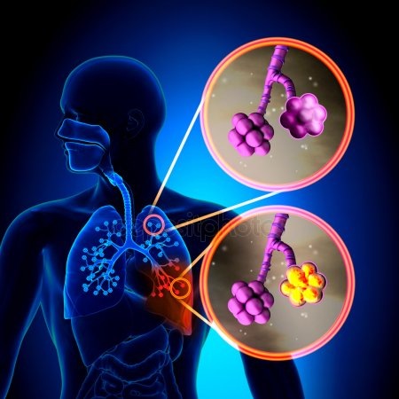 https://st.depositphotos.com/1909187/4809/i/450/depositphotos_48099843-stock-photo-pneumonia-normal-alveoli-vs-pneumonia.jpg