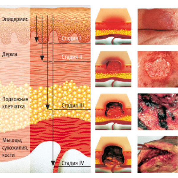 Стадии пролежней