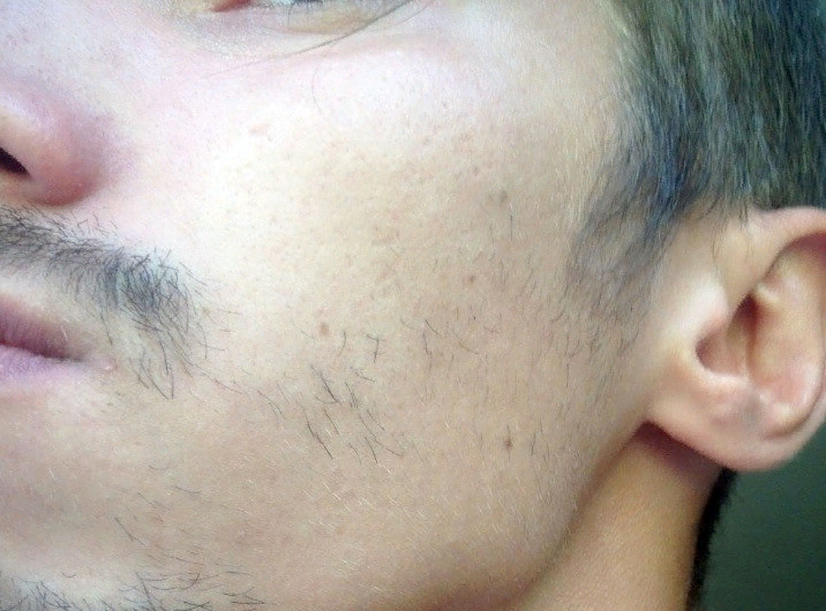 Почему появляется борода. Плохо растет борода. Неравномерная щетина. Растительность на лице у мужчин. Неравномерная растительность на лице.