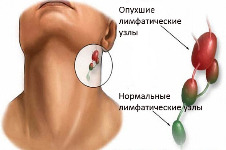 Лечение лимфатической системы на шее