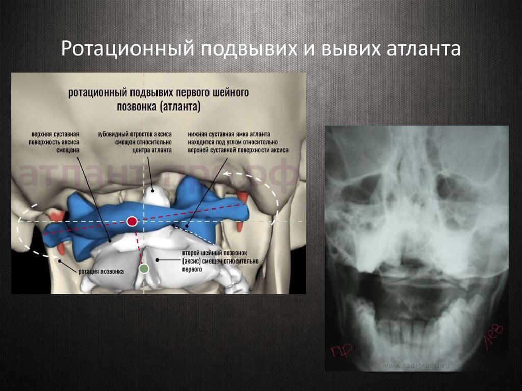 Ротационный подвывих Атланта с1. Ротационный подвывих с1 с2. Левосторонний ротационный подвывих с1. Подвывих шейного позвонка с1 Атлант.