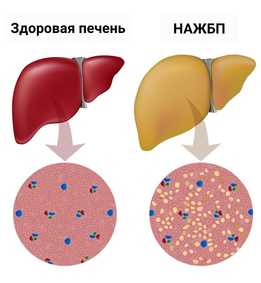 НАЖБП (неалкогольная жировая болезнь печени)