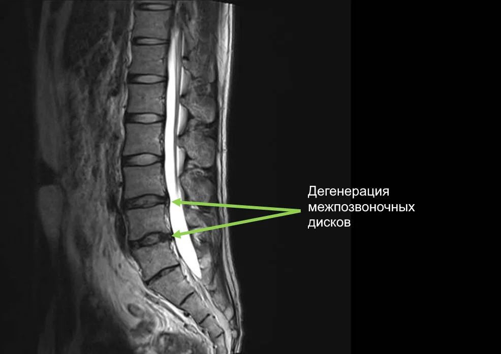 ГРЫЖА ПОЯСНИЧНОГО ОТДЕЛА ПОЗВОНОЧНИКА —