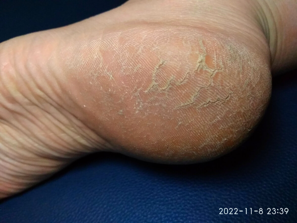 Внешние и внутренние разрывы доставляли сильный дискомфорт.