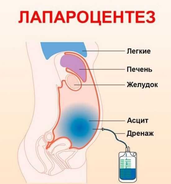 Асцит откачивание жидкости. Лапароцентез техника выполнения брюшной полости. Пункция жидкости брюшной полости.