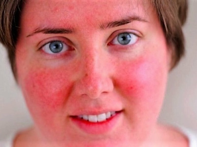 Почему часто краснеет лицо? | Pro-климакс | Дзен