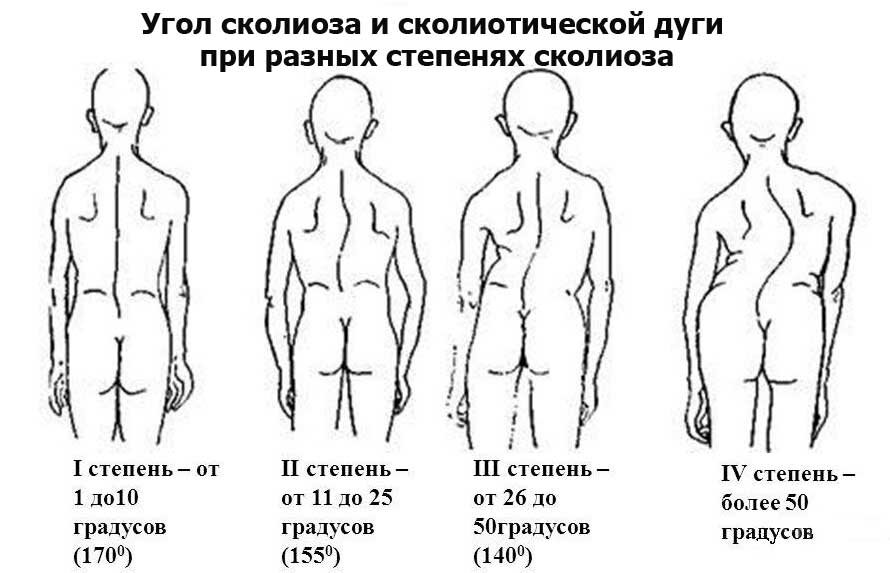 Корсет Шено - спасение от сколиоза