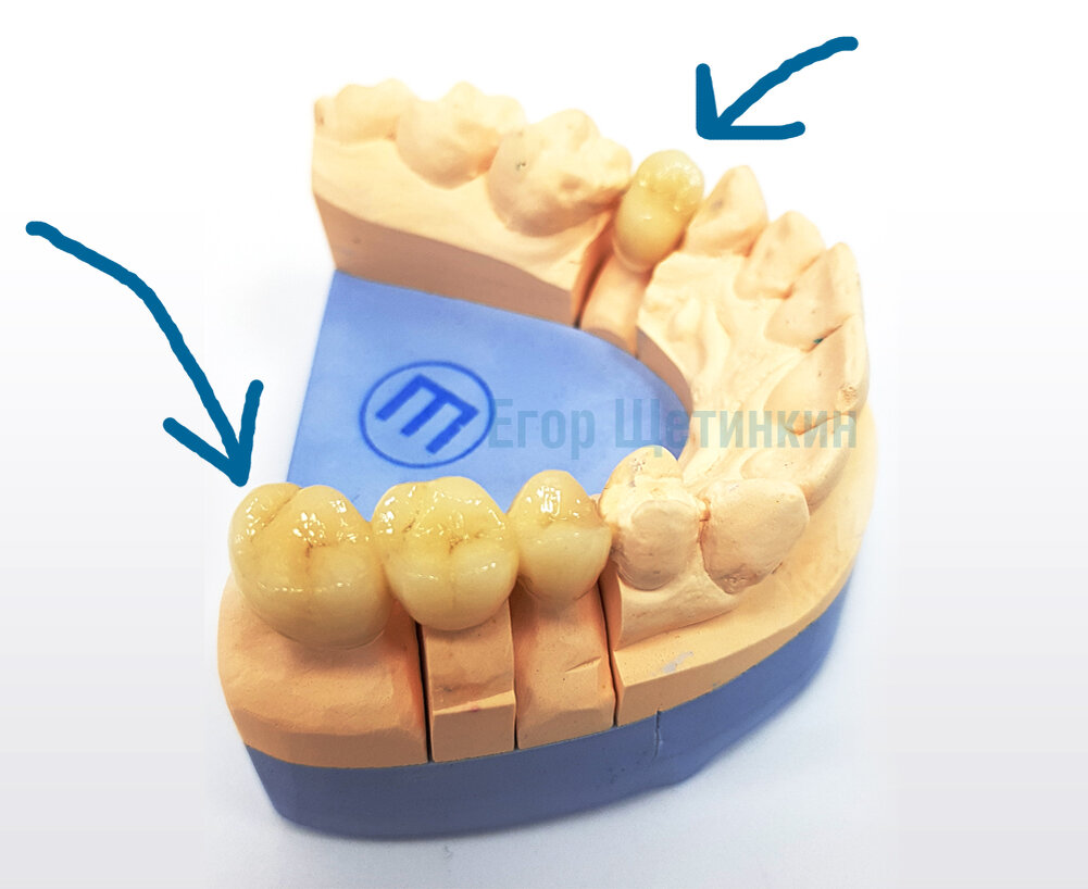 Коронка на зуб и мостовидный протез из трёх коронок