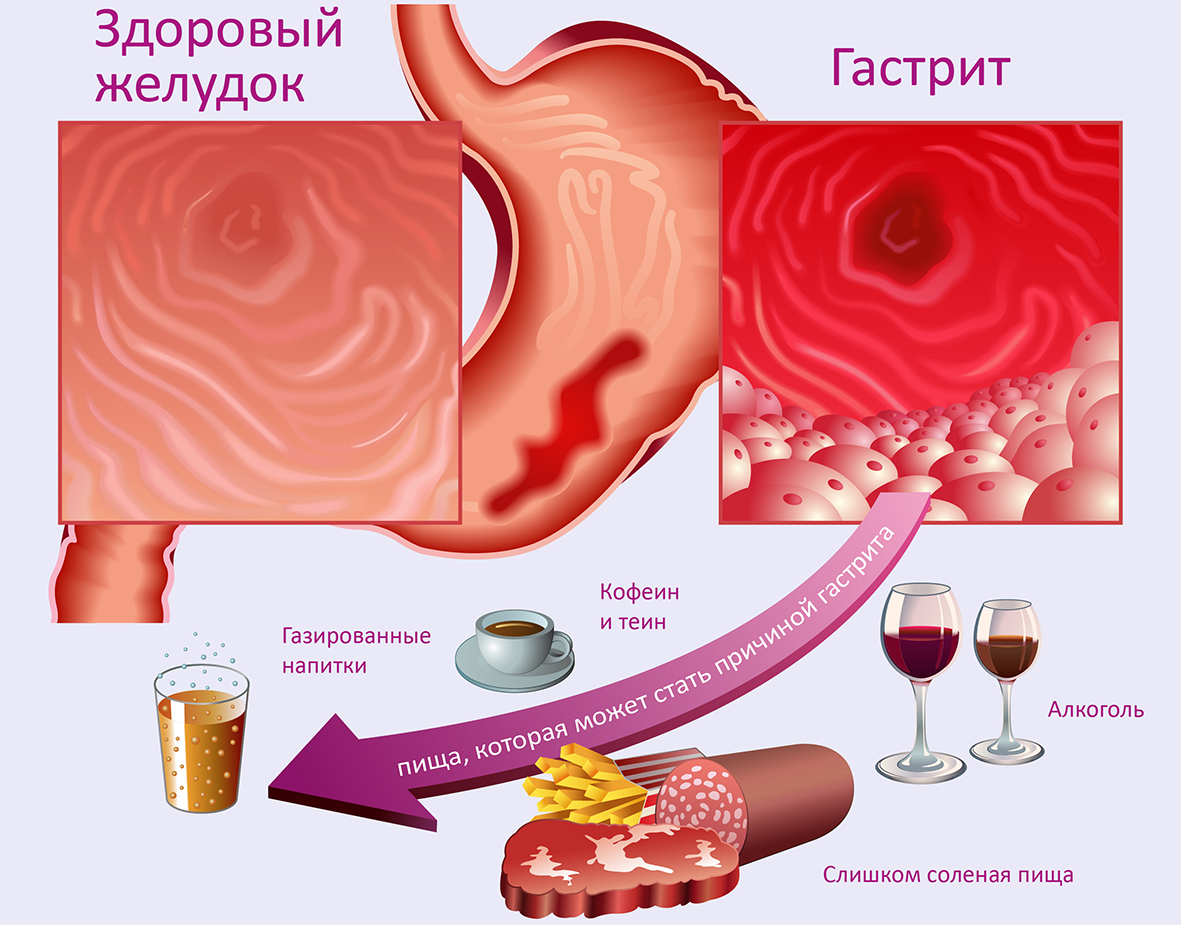 Гастрит локализация