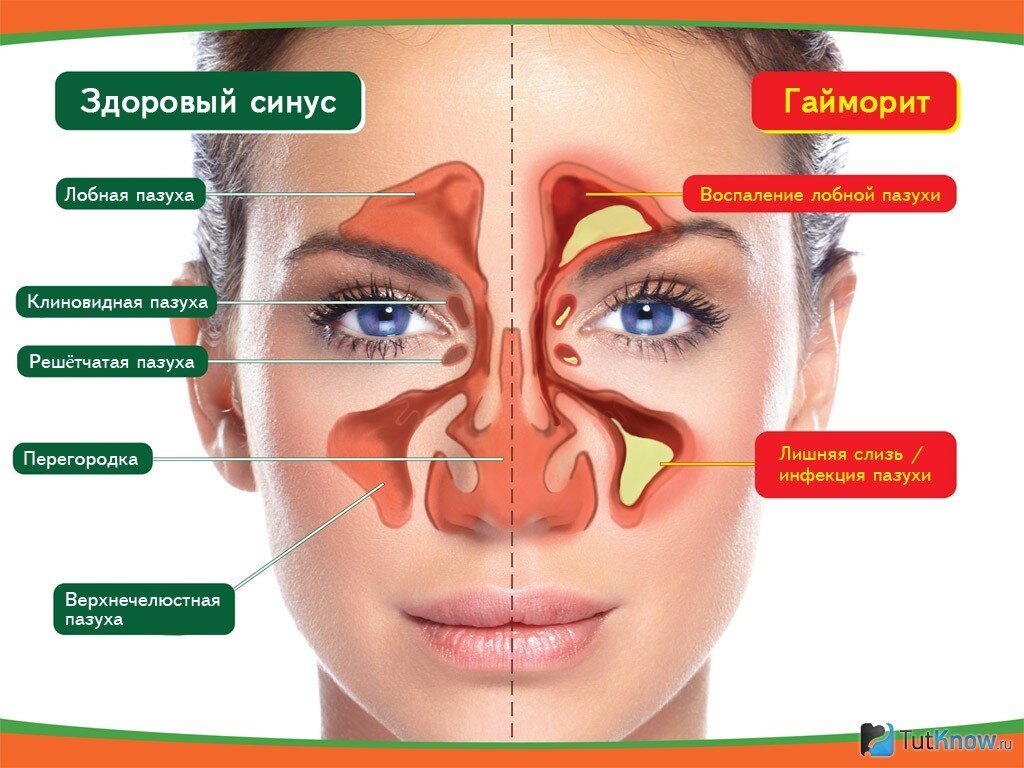 Гайморит. Как я избавилась от гайморита | Aricannna | Дзен