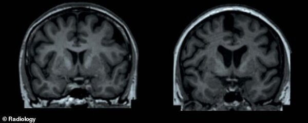 МРТ мозга женщин 65 лет