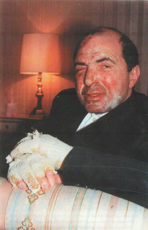 Борис Березовский после покушения