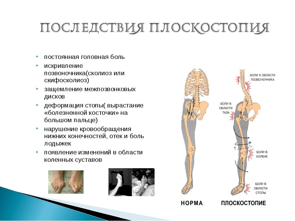 На рисунке изображено заболевание которое называется гигантизм косолапость плоскостопие сутулость