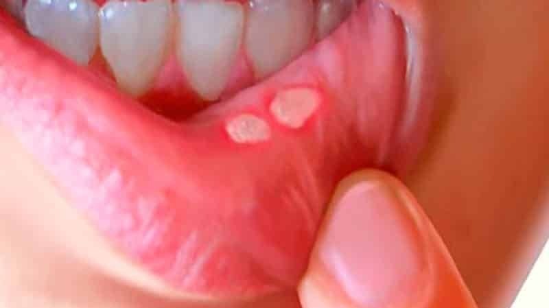 Крайне неприятное проявление воспаления слизистой, белые пятна