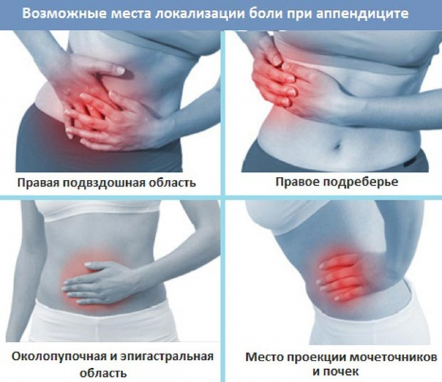 Болит живот потом. Где находится аппендицит.