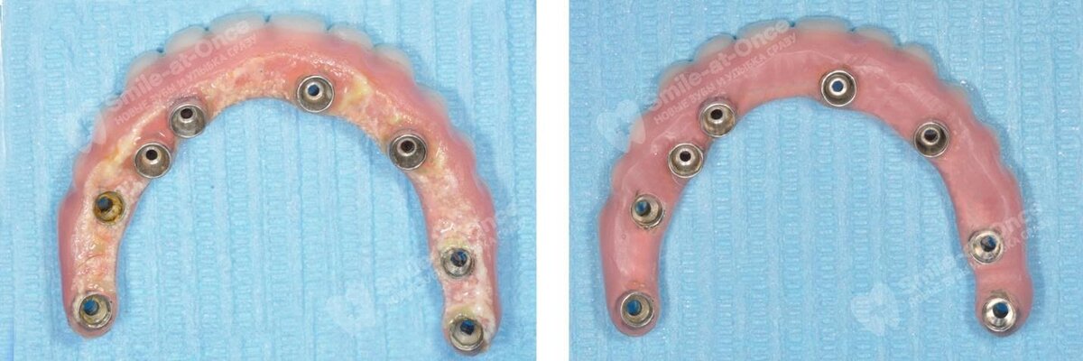 Протез с винтовым креплением на имплантах до и после профессиональной гигиены у стоматолога. Добиться такого эффекта самостоятельно невозможно, даже если использовать самую лучшую пасту. Фото: Smile-at-Once.ru.
