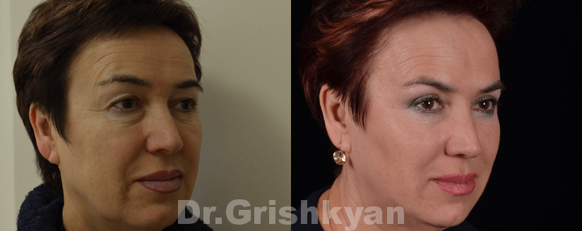 Подтяжка лица SMAS фото до и после. Фото с сайта Д.Р. Гришкяна. Имеются противопоказания, требуется консультация специалиста