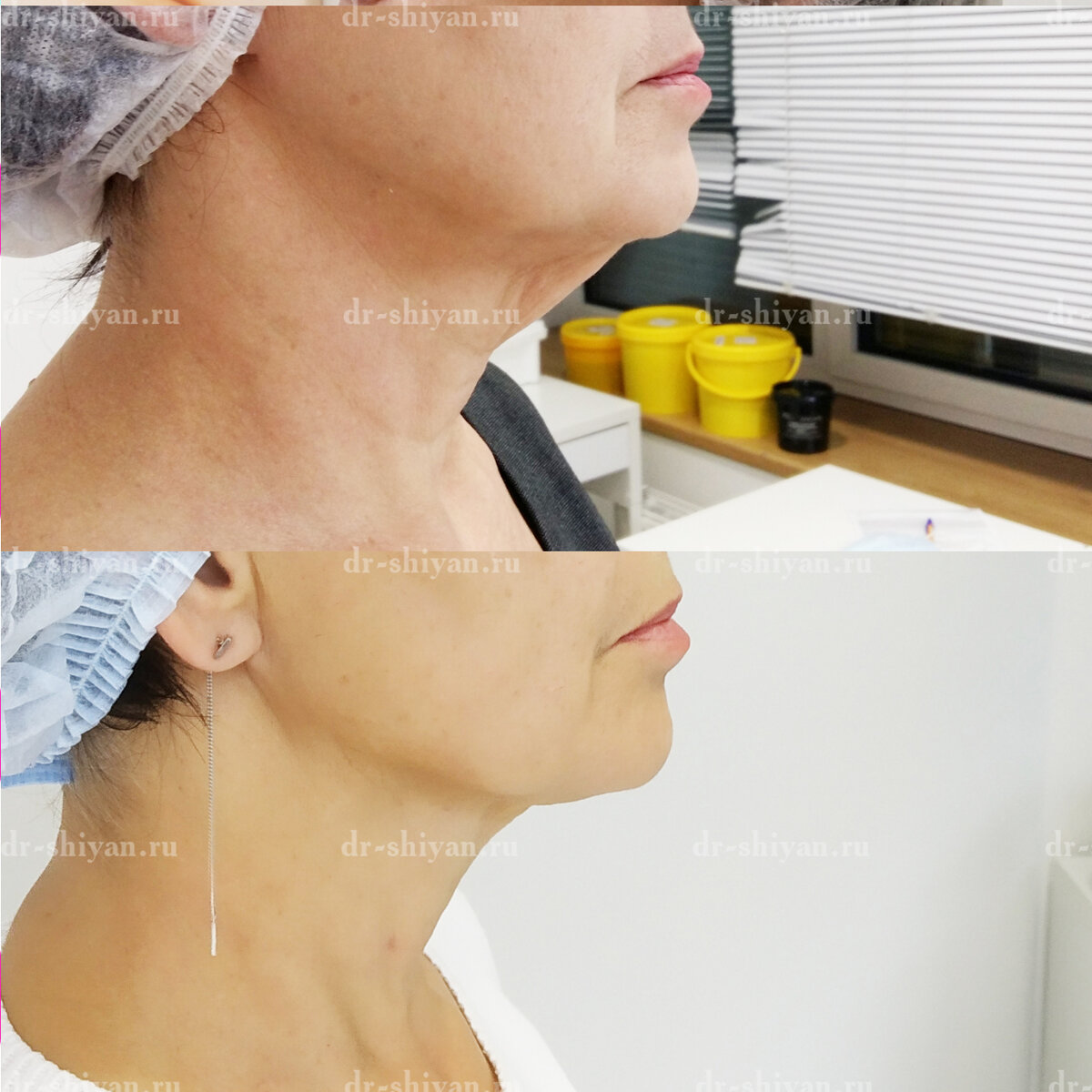 был проведен нитевой лифтинг  подбородочной области и овала лица