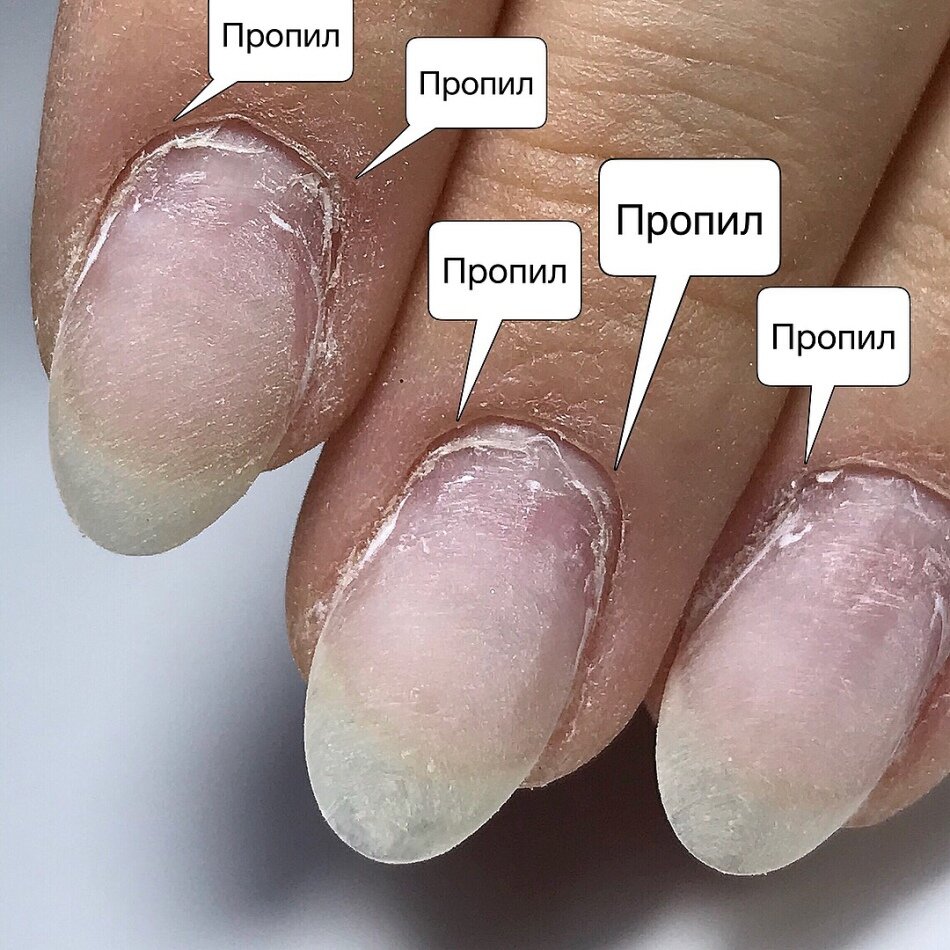Пропилы ногтя.