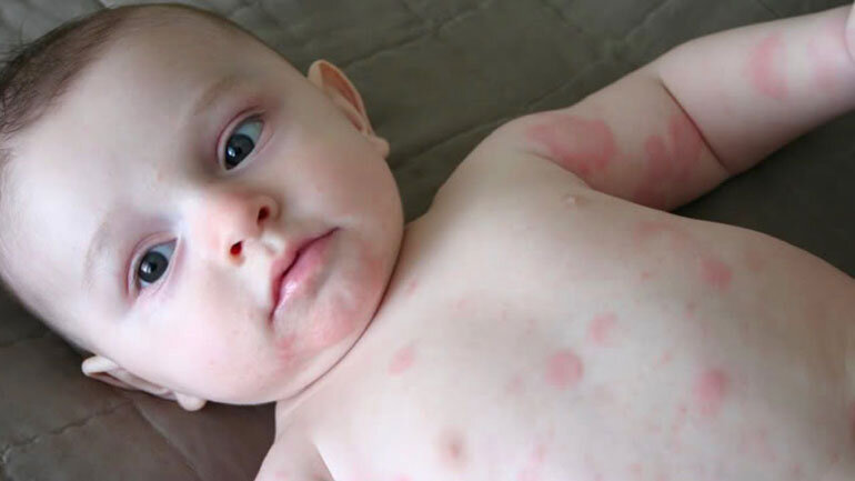 Аллергия на антибиотик!!!Было у кого такое? - 28 ответов - Детское здоровье - Форум Дети luchistii-sudak.ru