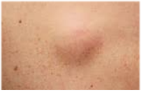 Шишка после укола