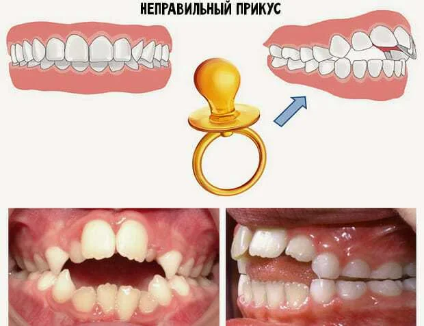 Открытый прикус в переднем отделе (на фото уже ранний сменный прикус, возраст 7 лет)