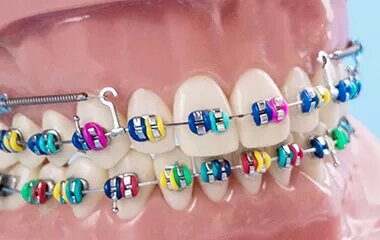 Лигатурные брекет-системы