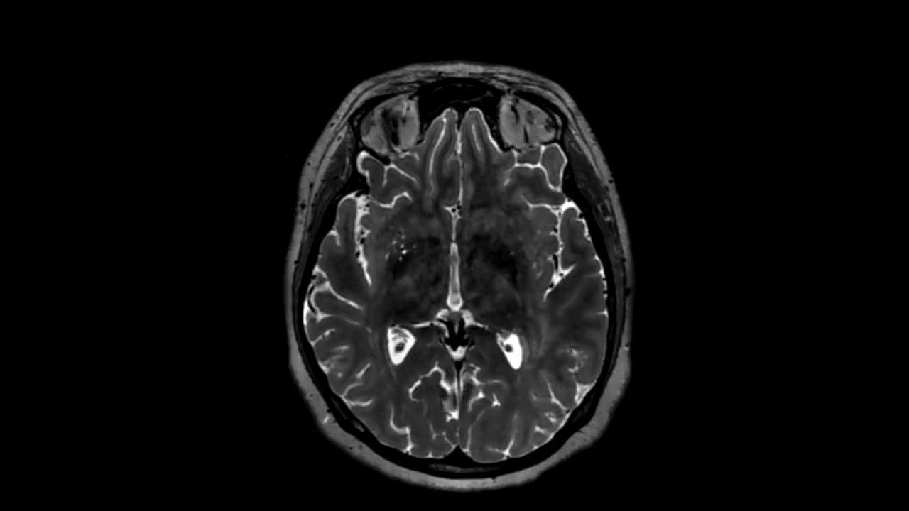 Как делают МРТ головного мозга, что видно (видео) | Все о КТ и МРТ | Дзен