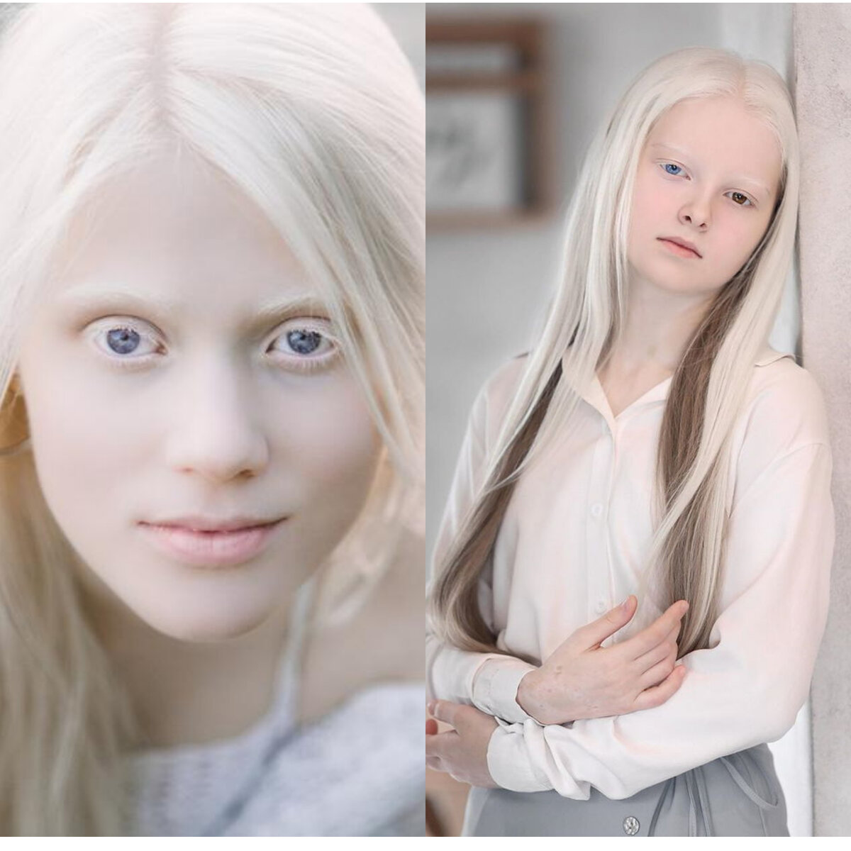 Как люди рождаются альбиносами. Монголоиды альбиносы. Глазокожный альбинизм. Европеоид альбинос. Глазокожный альбинизм 1 а.