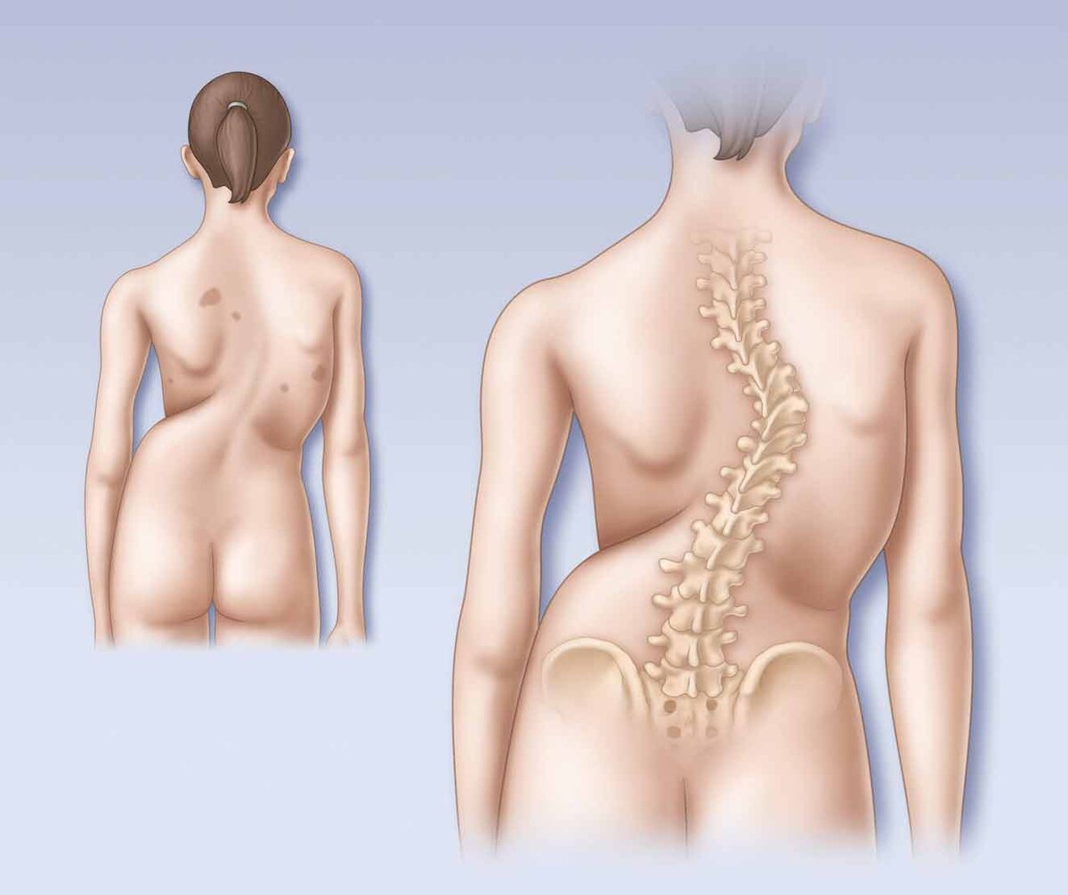 Взаимосвязь между неправильным прикусом и осанкой – Ortholike