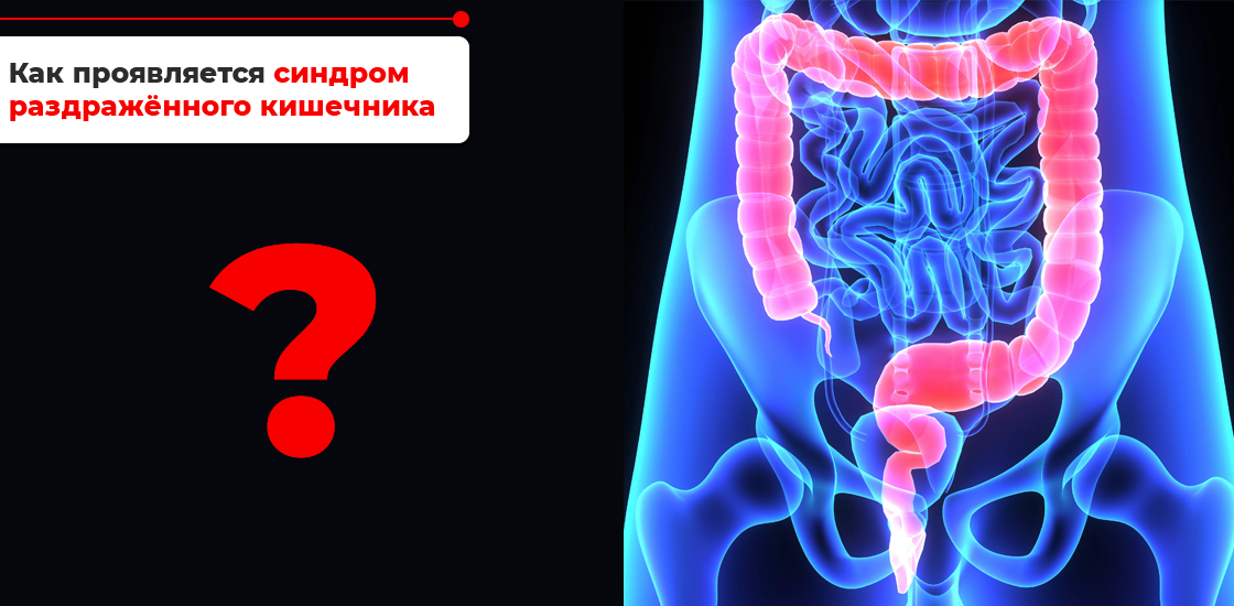 Синдром раздраженного кишечника