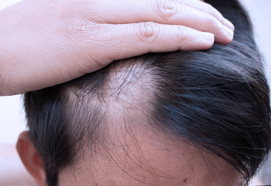 Лечение выпадение волос у мужчин: проблемные волосы у мужчин, что надо знать