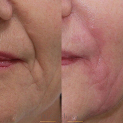 Коррекция морщин филлерами