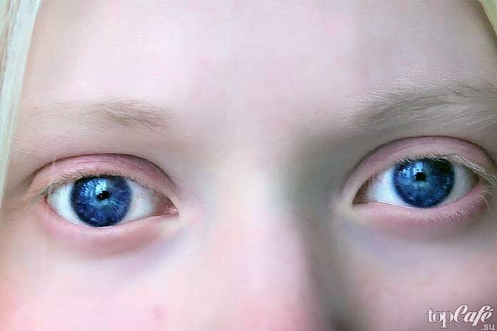 Амаль софи альбинос. Признак альбиноса 8. Альбинизм наследственное заболевание у человека. Признак альбиноса 8. Глазокожный альбинизм 1 гка.