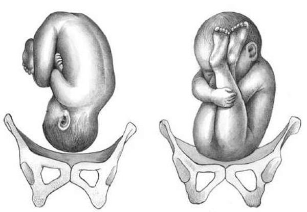 Тазовое предлежание – как повернуть малыша