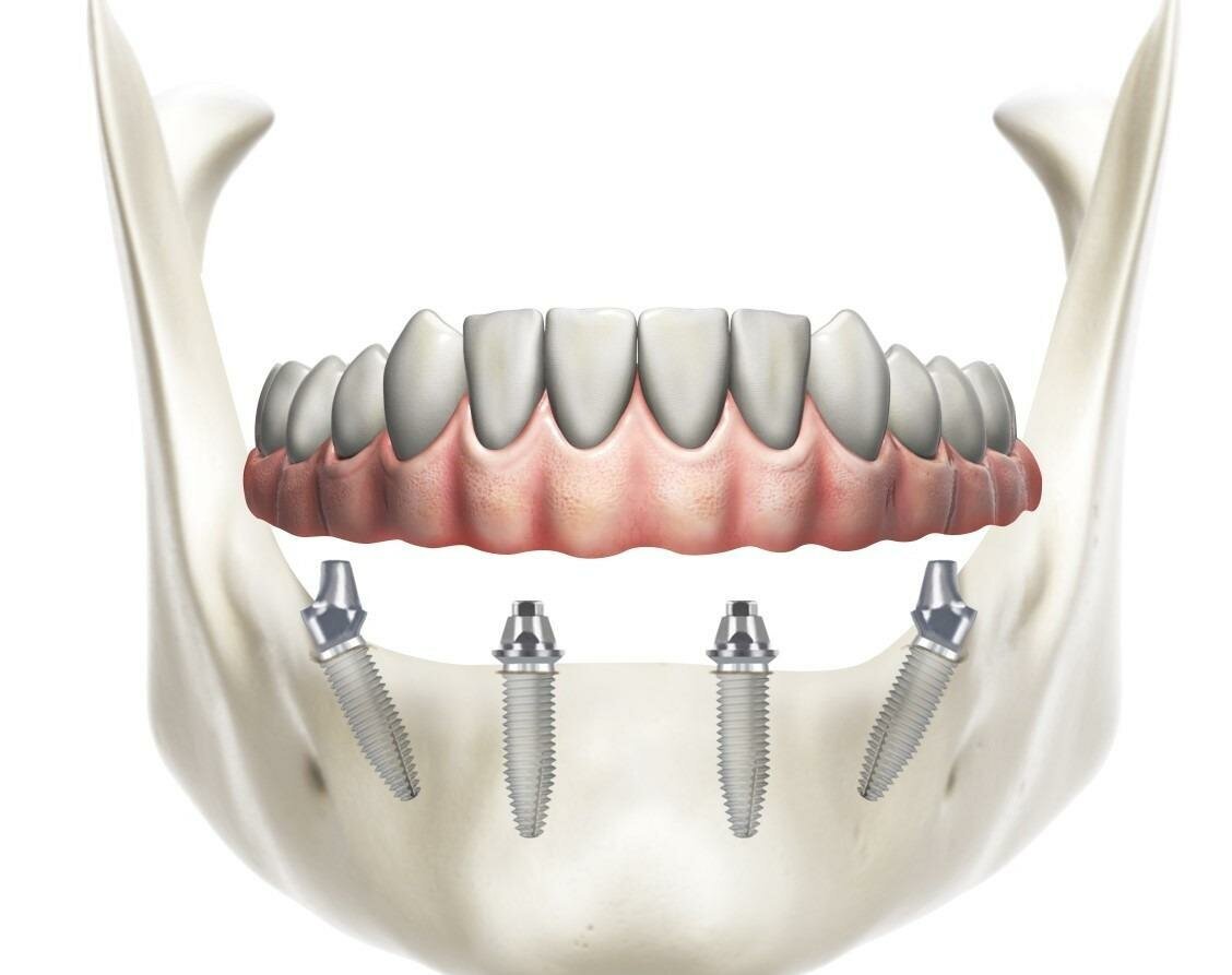 имплантация всех зубов за один день