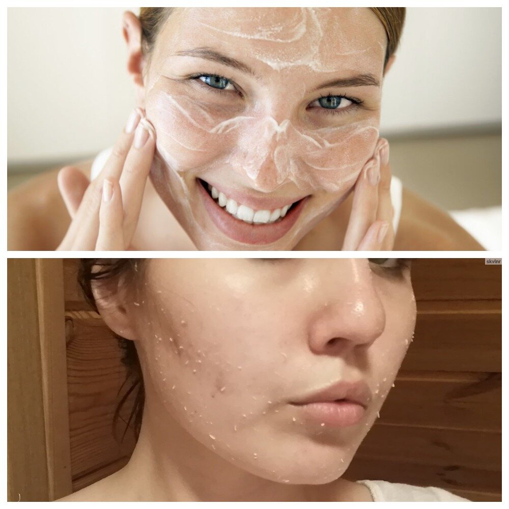 Saem peeling