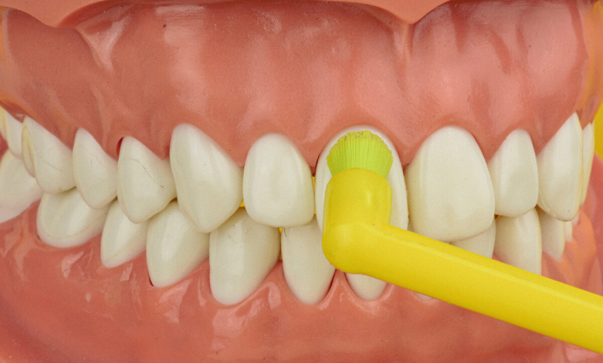 Монопучковая щетка относительно одного зуба.