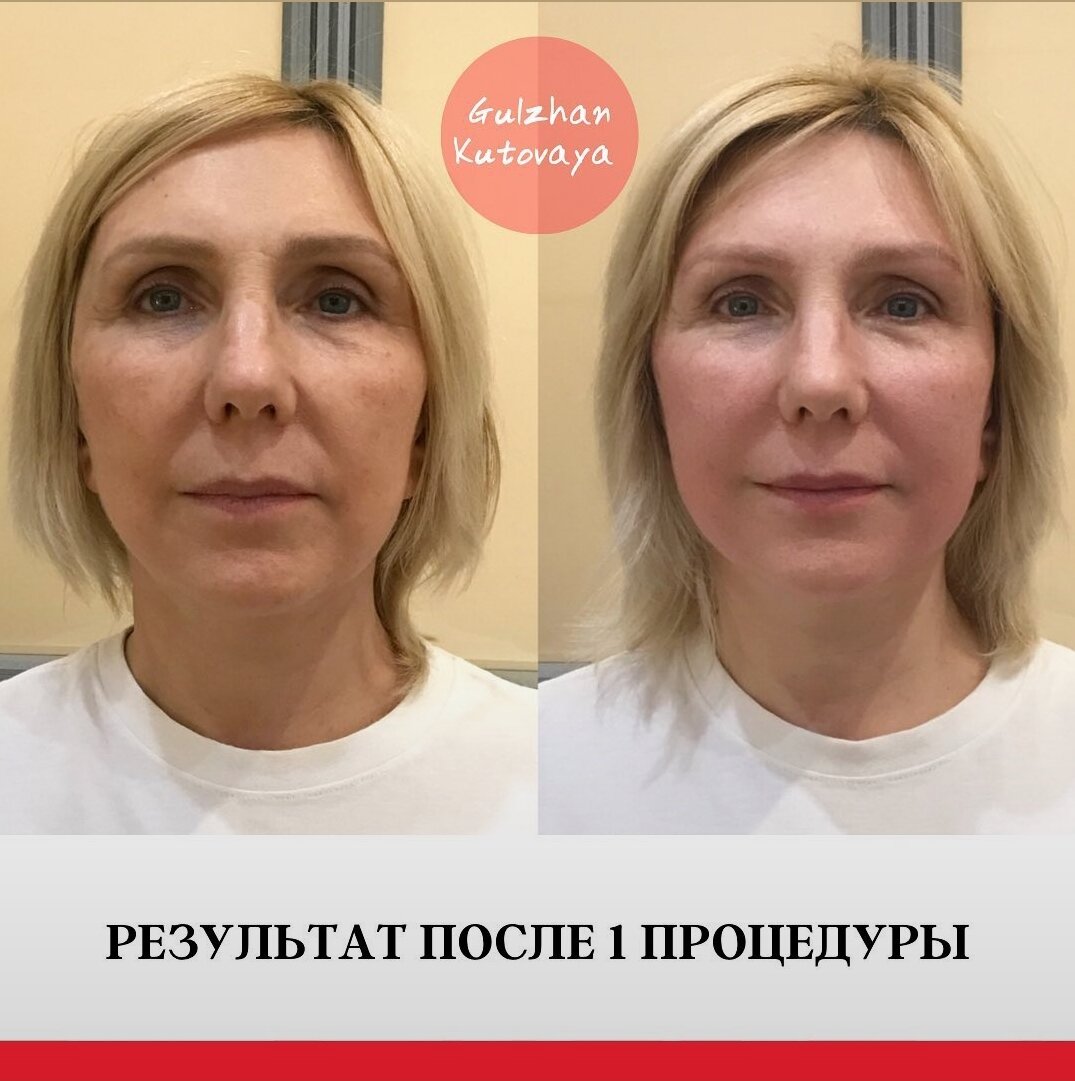 Массаж коруги отзывы фото до и после