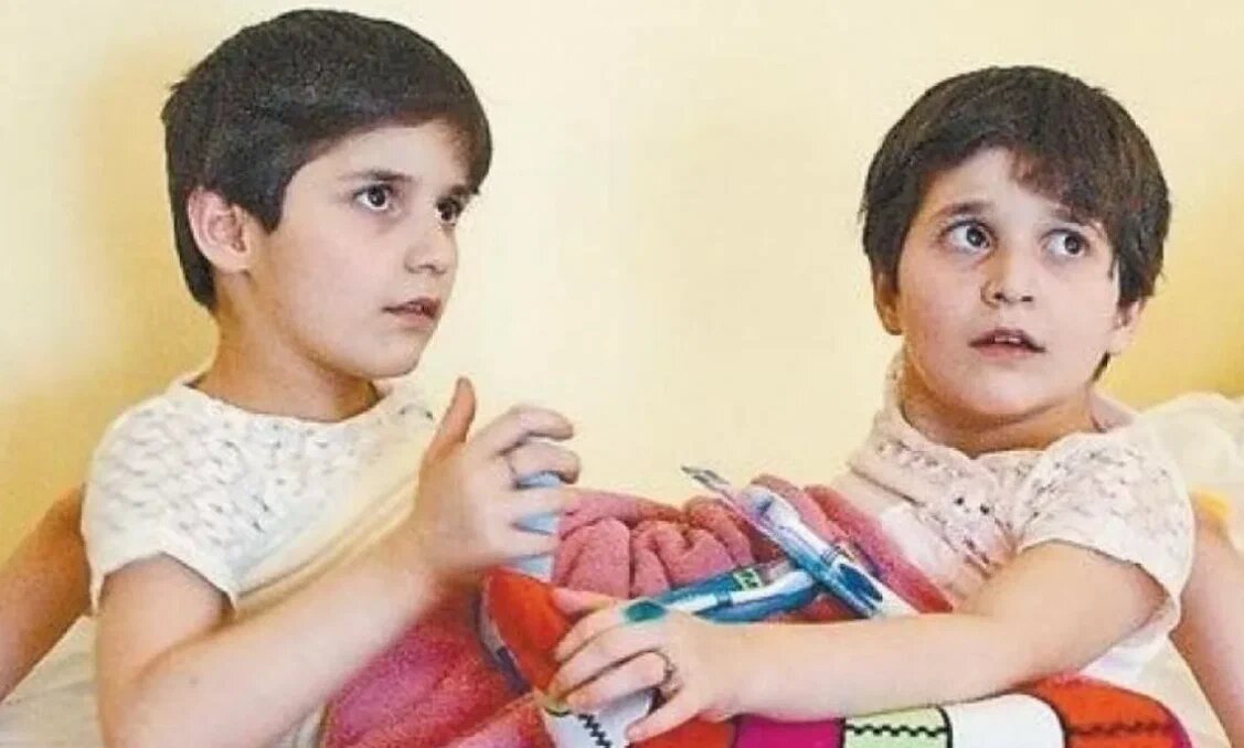 зита и гита резахановы. сиамские близнецы зита и гита резахановы. близнецы зита и гита резахановы сейчас. гита близнецы. сёстры зита и гита резахановы.