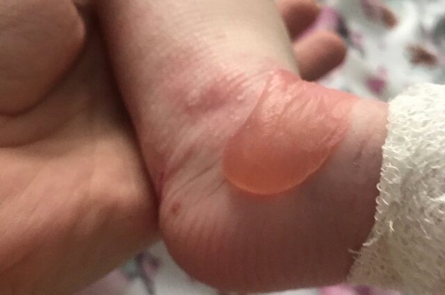    Такие пузыри появляются на теле Мии каждое утро. Фото: личный архив/ Светлана Марченко