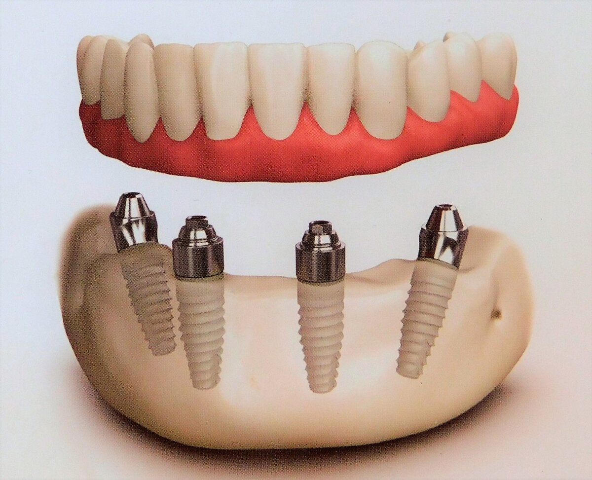 Имплант гуд. Базальная имплантация 4 Осстем. Имплантация зубов Osstem. All on 4 базальная имплантация.