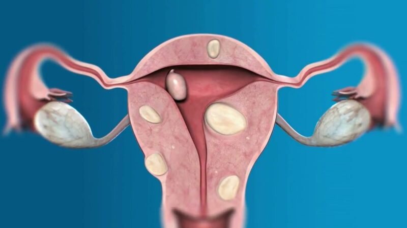 В репродуктивном периоде миомы вырастают у 30—40% женщин, причем очень часто без всяких симптомов