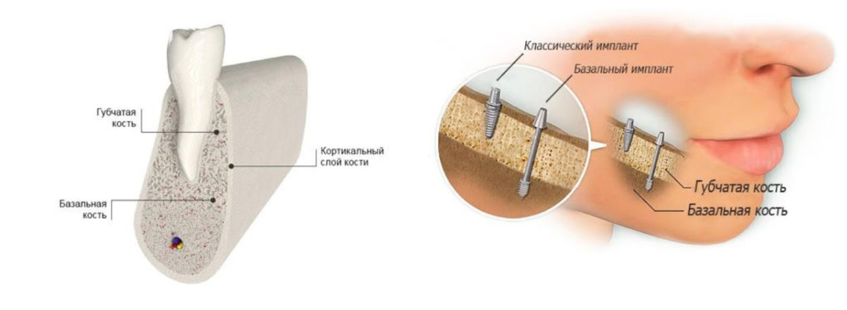 Базальная имплантация что это такое простыми словами. Базальные импланты институт. Протокол базальных имплантов.