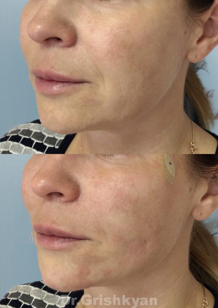 Фото до и после подтяжки нитями. Фото с сайта Д.Р. Гришкяна. Имеются противопоказания, требуется консультация специалиста