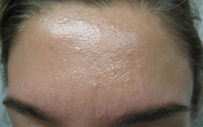 Закупорка сальных желез