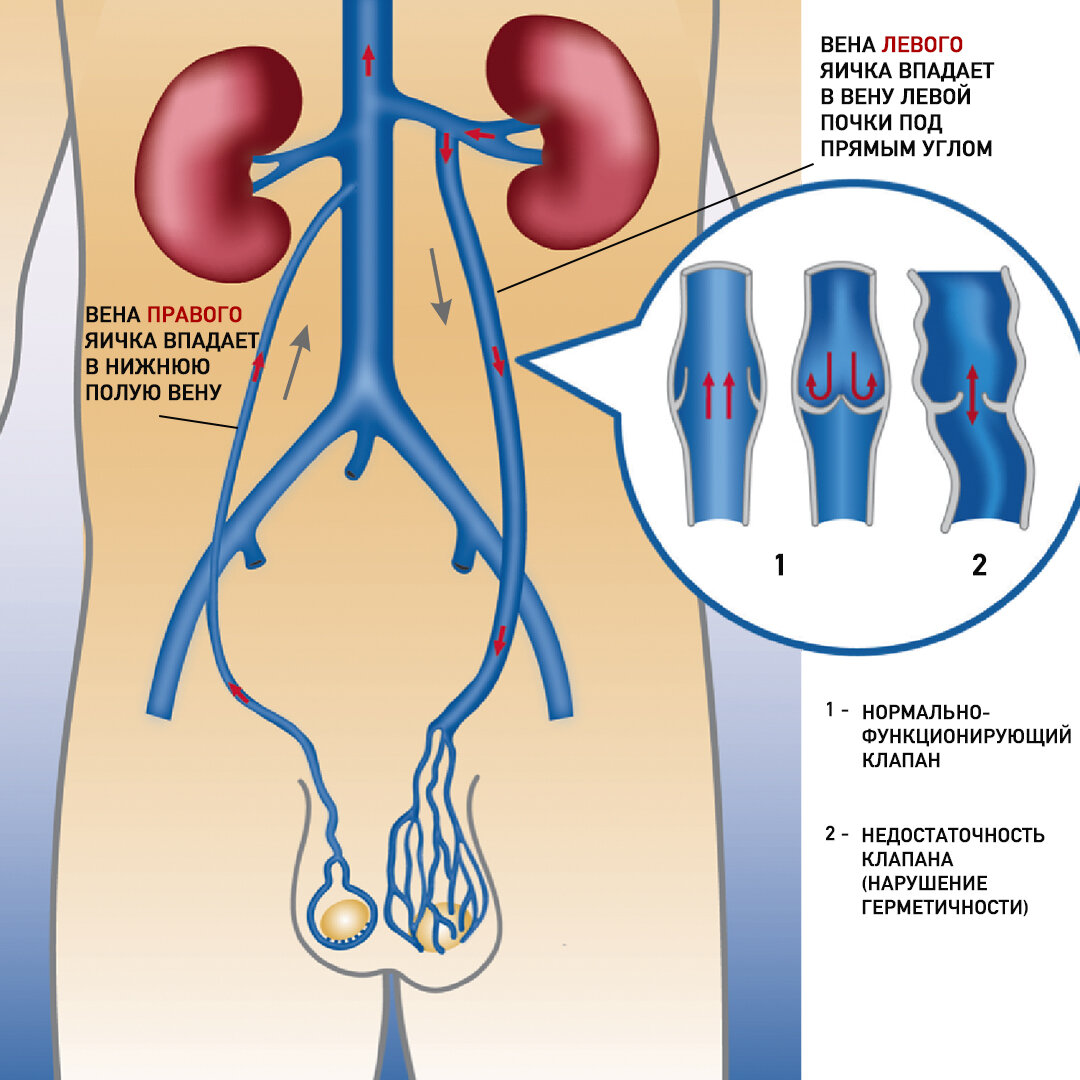 Варикоцеле. Что это? | Константин Меньщиков | Дзен
